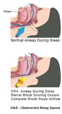 Obstructive Sleep Apnea - normal and blocked airflow