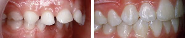 Under Developed Jaw corrected with Healthy Start System </p> <h3>Benefits of the HealthyStart® System