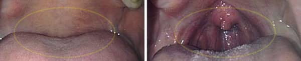 Open-bite corrected with Healthy Start System