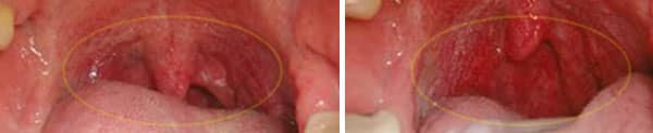 Open-bite corrected with Healthy Start System